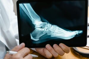 Profilaktyka osteoporozy: jak dbać o zdrowie kości?